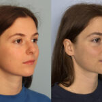 rhinoplasty-merged