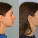 rhinoplasty-merged