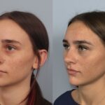rhinoplasty-merged