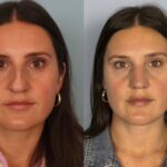 rhinoplasty-merged