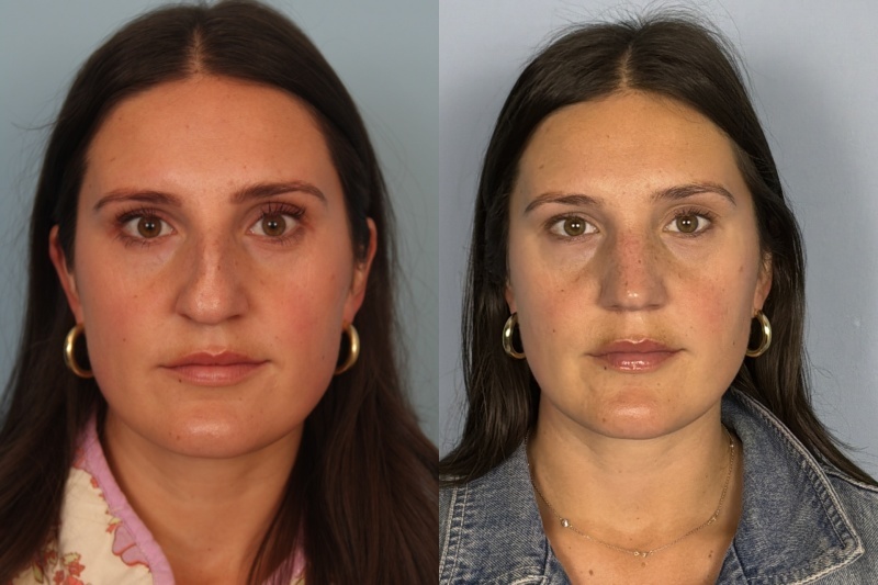 before_after_img