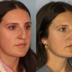 rhinoplasty-merged