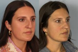 before and after rhinoplasty