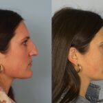 rhinoplasty-merged