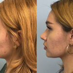rhinoplasty-merged