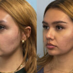 rhinoplasty-merged