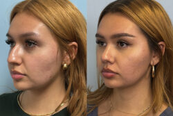 before and after rhinoplasty