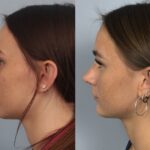 rhinoplasty-merged