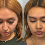rhinoplasty-merged