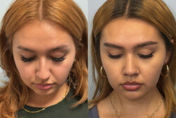 before and after rhinoplasty
