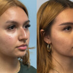 rhinoplasty-merged