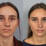 rhinoplasty-merged