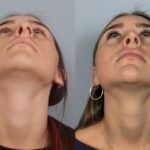 rhinoplasty-merged