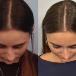 rhinoplasty-merged