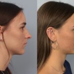 rhinoplasty-merged
