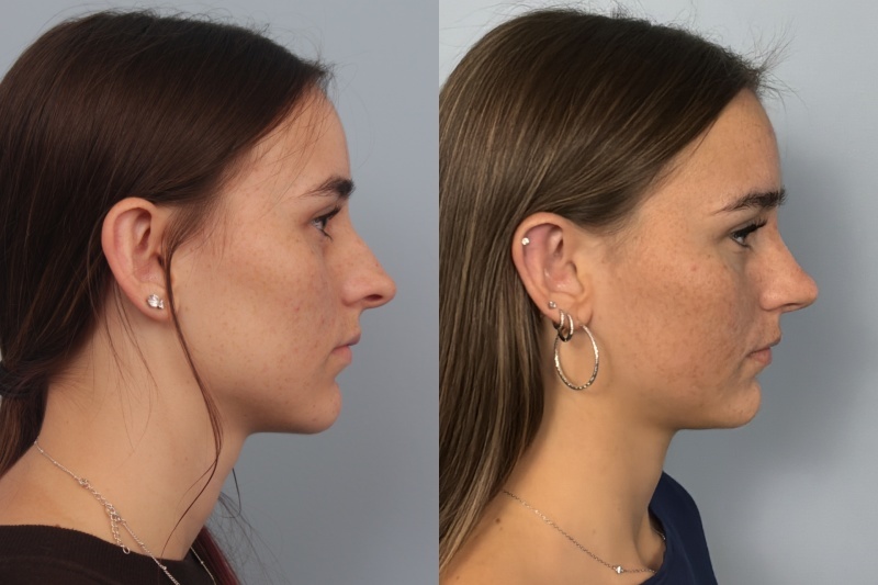 before_after_img
