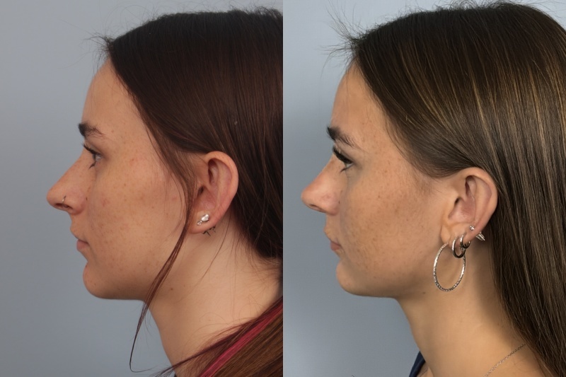 before_after_img