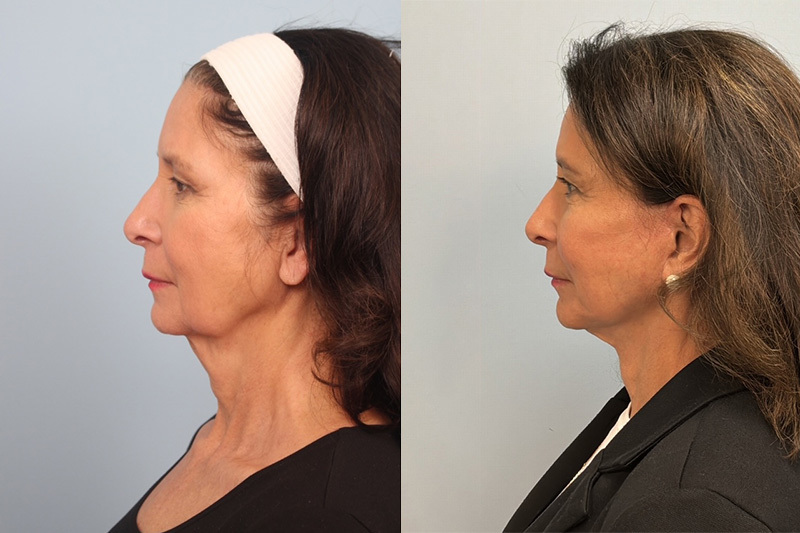 before_after_img