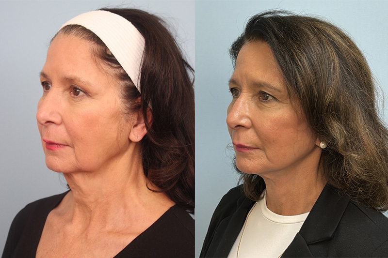 before_after_img