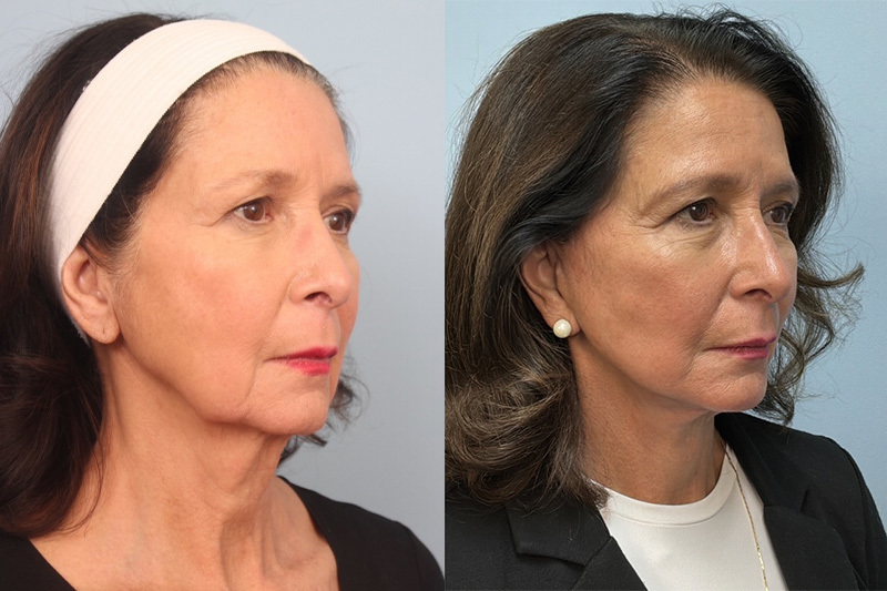 before_after_img