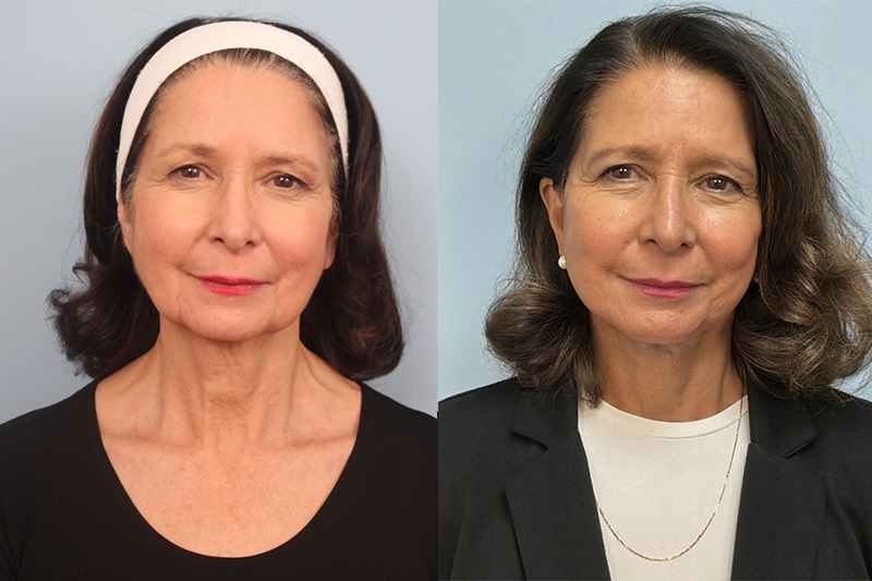 before_after_img